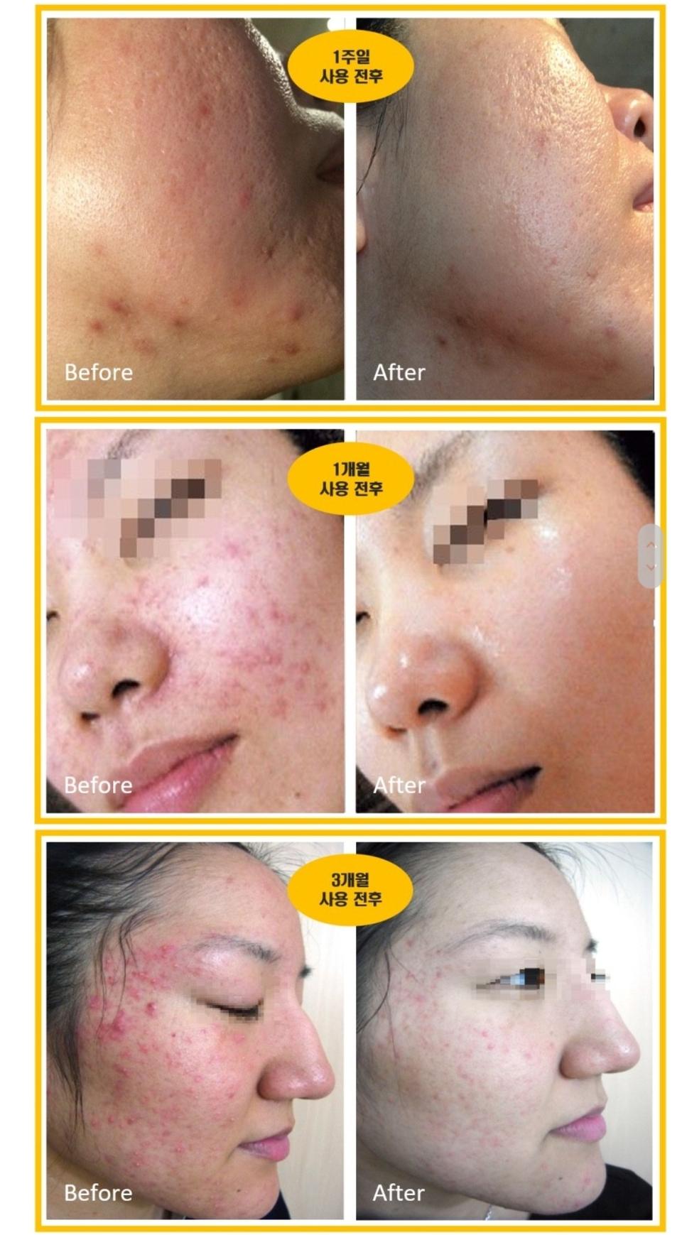 모공 좁쌀 여드름 모낭염 홍조 가 고민이라면 늦기전에 사용하세요