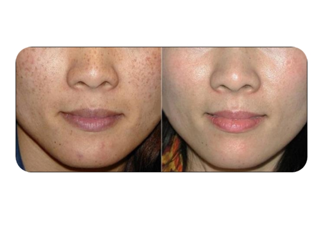 기미 잡티 레이저할돈아껴서집에서꾸준히관리하는게현명한방법