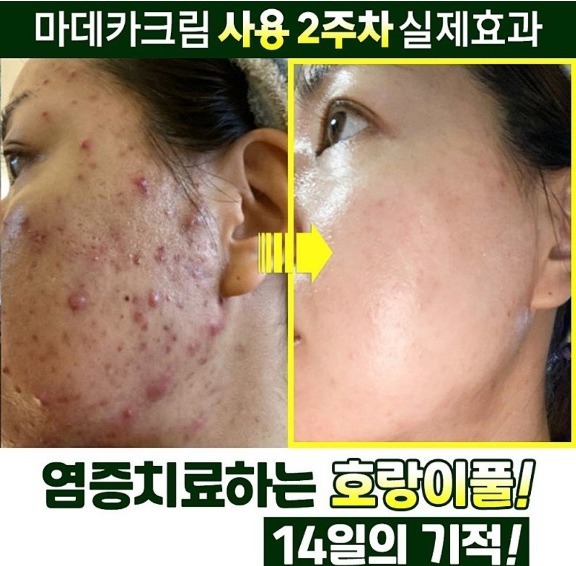 피부재생 상처 트러블 여드름염증 색소침착 튼살 모공 여드름흉터 화장품