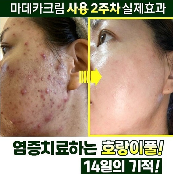 피부재생 상처 트러블 여드름염증 색소침착 튼살 모공 여드름흉터 화장품