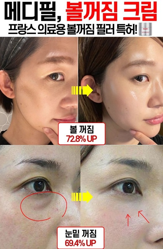 볼복구크림 볼 꺼짐 이마, 볼,눈밑, 화장품 필러 에센스 앰플 메디필