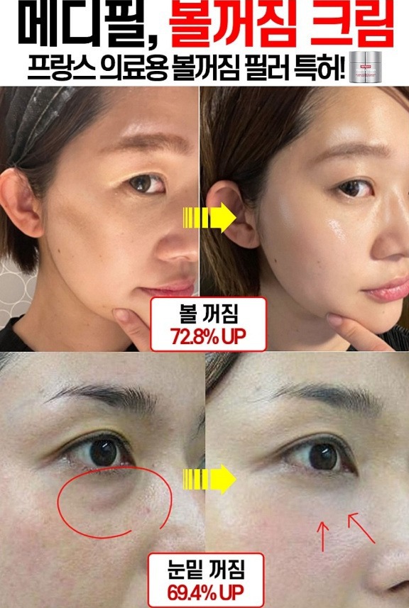 볼복구크림 볼 꺼짐 이마, 볼,눈밑, 화장품 필러 에센스 앰플 메디필