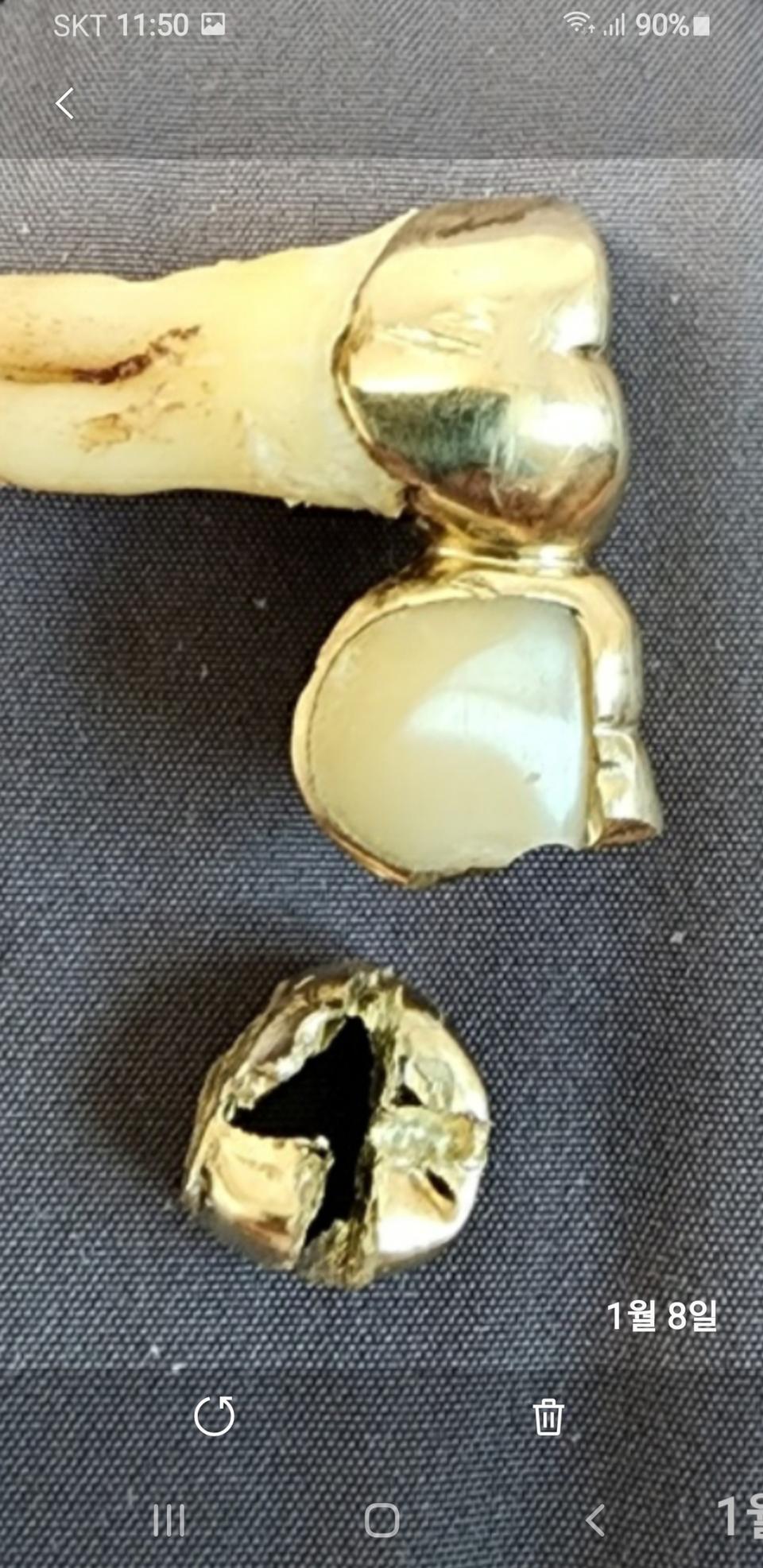 금니가격 금이빨 판매 폐금니 매입