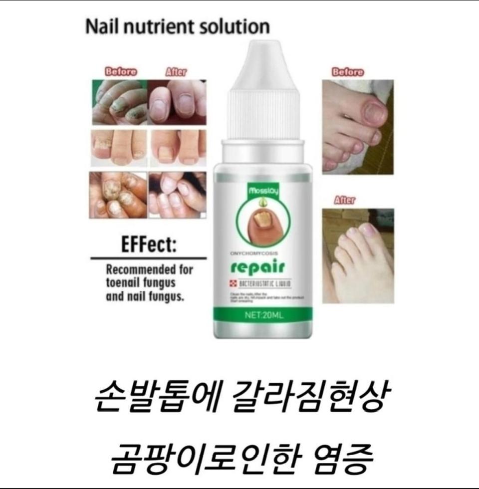 2일무료배송 브랜드 발톱치료 손톱크림 약 해외극찬 습진 연고 무좀 발가락